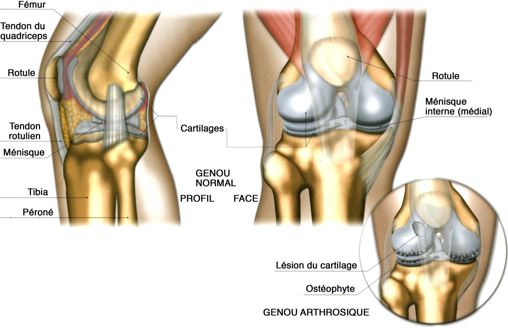 gonarthrose arthrose du genou ménisque
