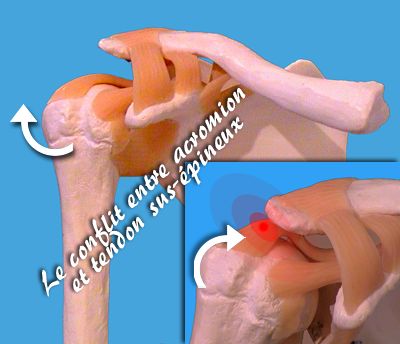 soigner une tendinite épaule soigner une tendinite épaule