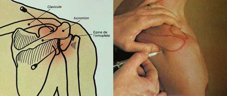 epaule_post.jpg